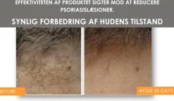 Ichtilix Forte, Præparat mod skæl og flager på hårbærende områder