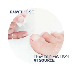 Neglesvampsbehandling