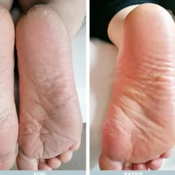 Pakke mod Sure Tæer